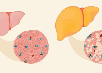 Ar trebui să folosesc un regenerator hepatic dacă am ficatul gras?