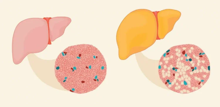 Ar trebui să folosesc un regenerator hepatic dacă am ficatul gras?